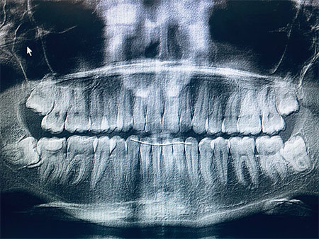 Digital X-Rays