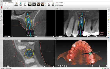 Implant Planning Software
